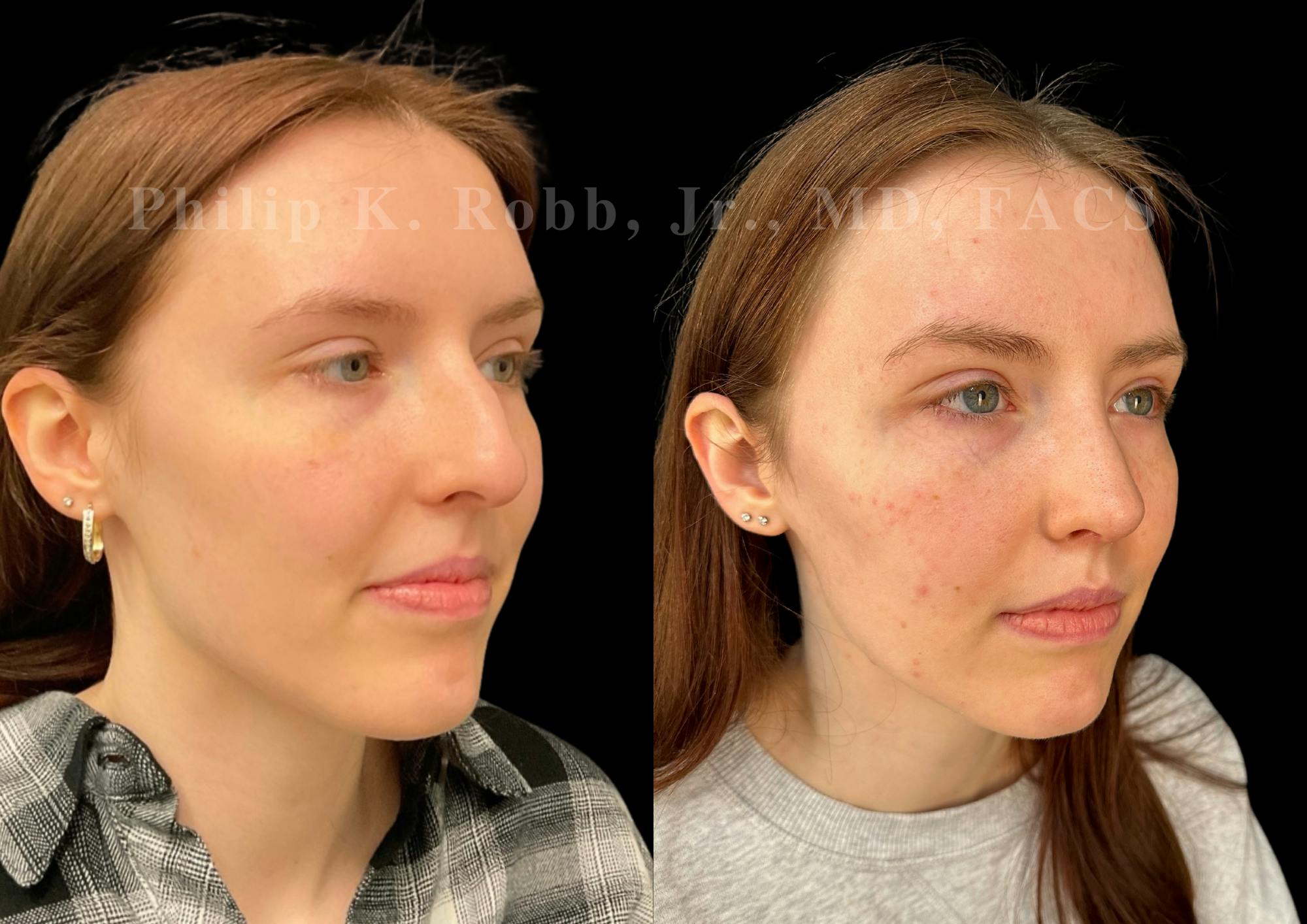 Ultrasonic Rhinoplasty Before & After Gallery - Patient 303760 - Image 2
