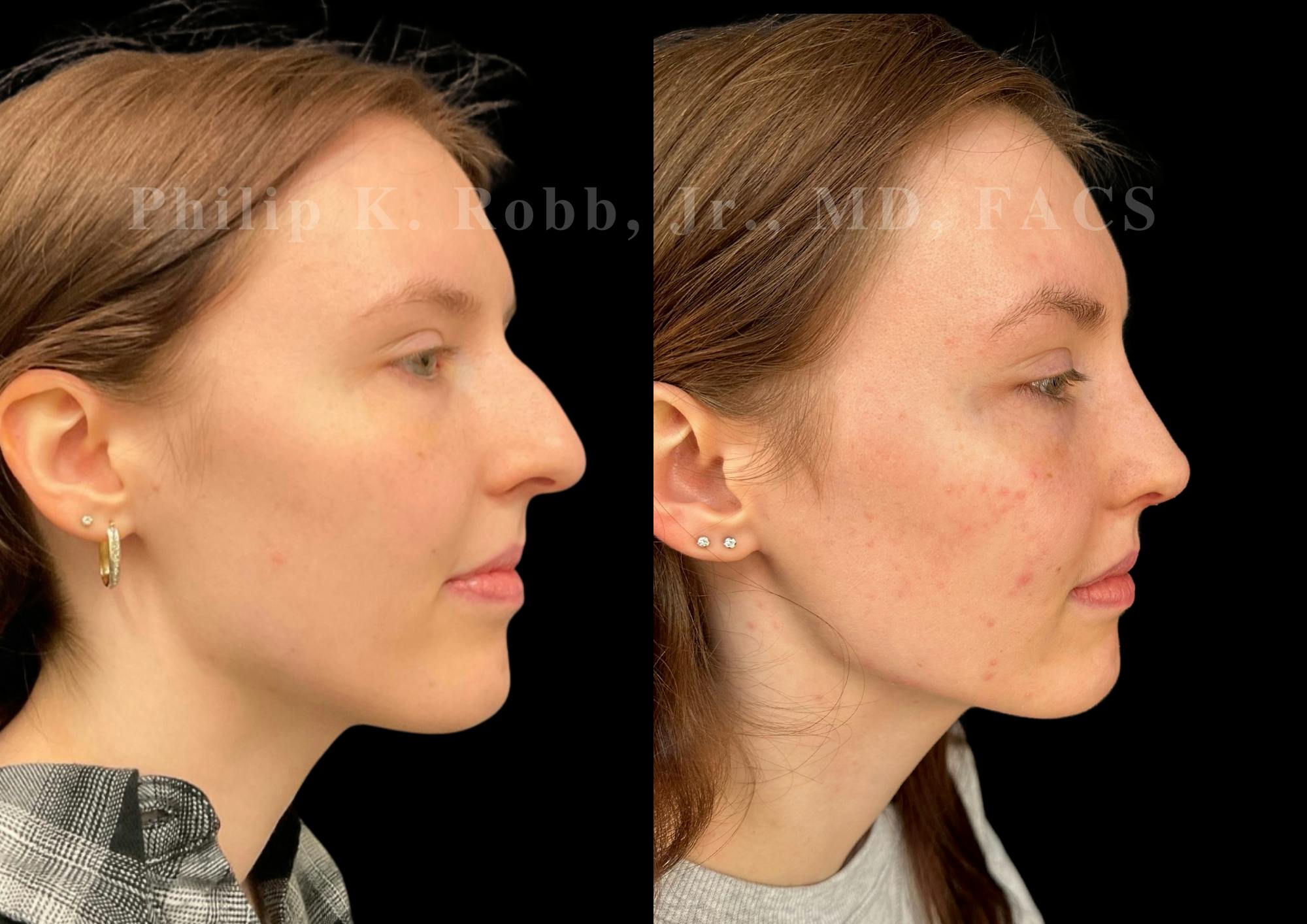 Ultrasonic Rhinoplasty Before & After Gallery - Patient 303760 - Image 1