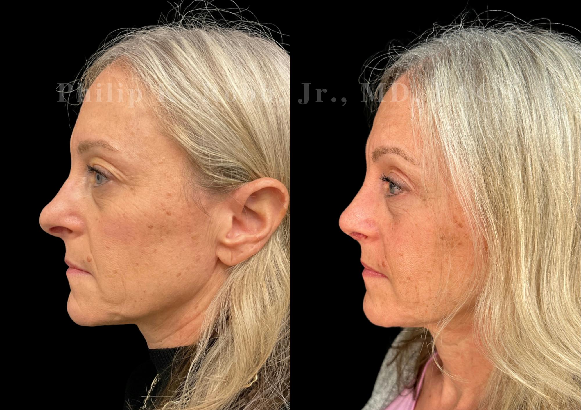 Ultrasonic Rhinoplasty Before & After Gallery - Patient 423083 - Image 5