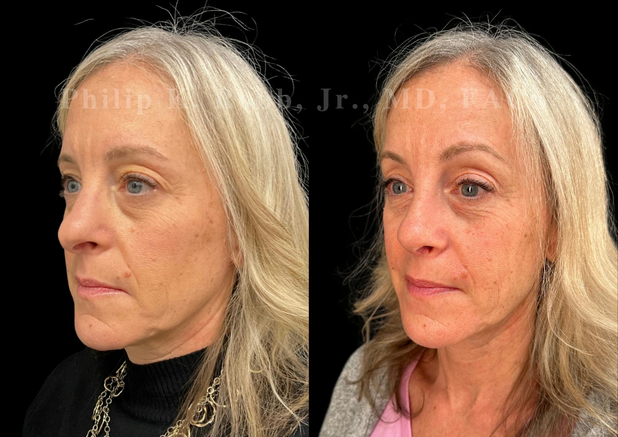 Ultrasonic Rhinoplasty Before & After Gallery - Patient 423083 - Image 4