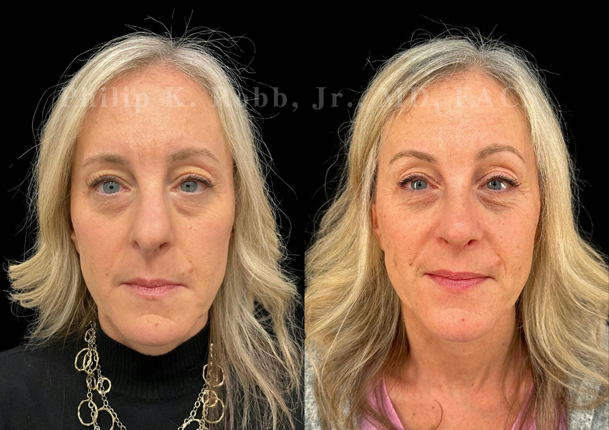 Ultrasonic Rhinoplasty Before & After Gallery - Patient 423083 - Image 3