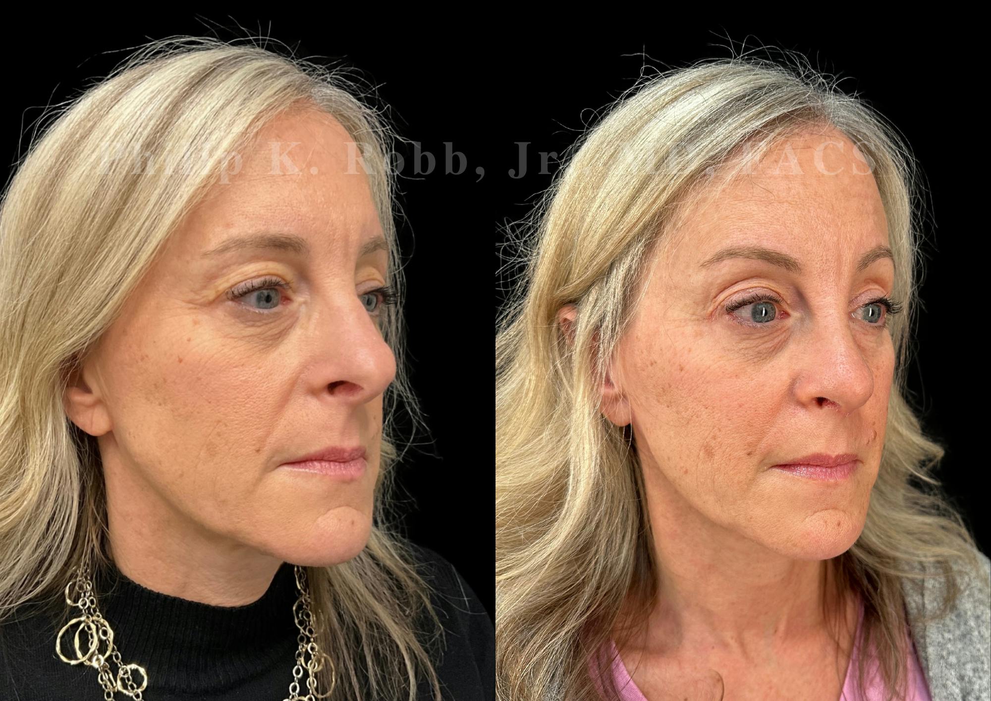 Ultrasonic Rhinoplasty Before & After Gallery - Patient 423083 - Image 2
