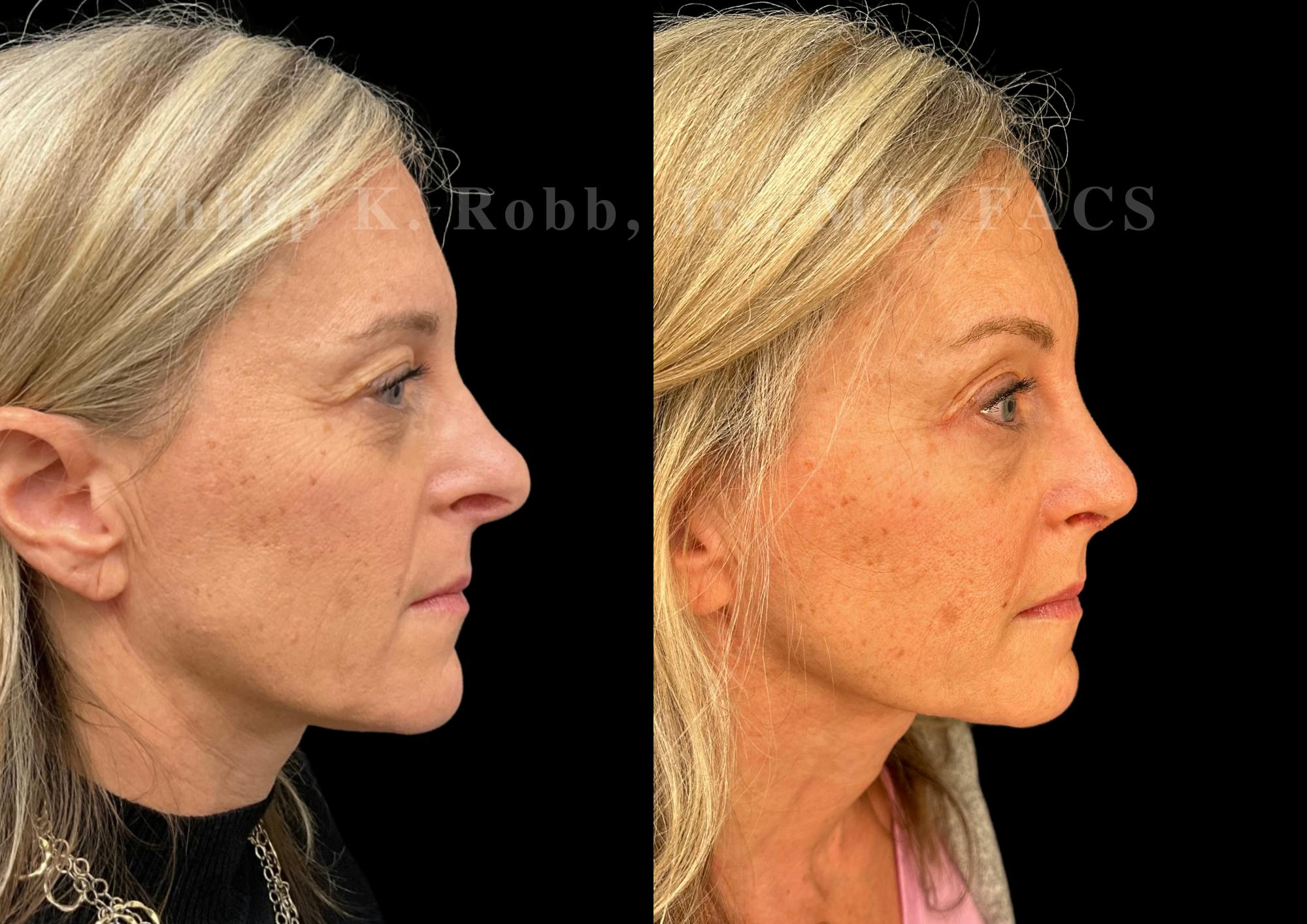 Ultrasonic Rhinoplasty Before & After Gallery - Patient 423083 - Image 1