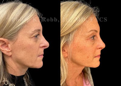 Ultrasonic Rhinoplasty Before & After Gallery - Patient 423083 - Image 1