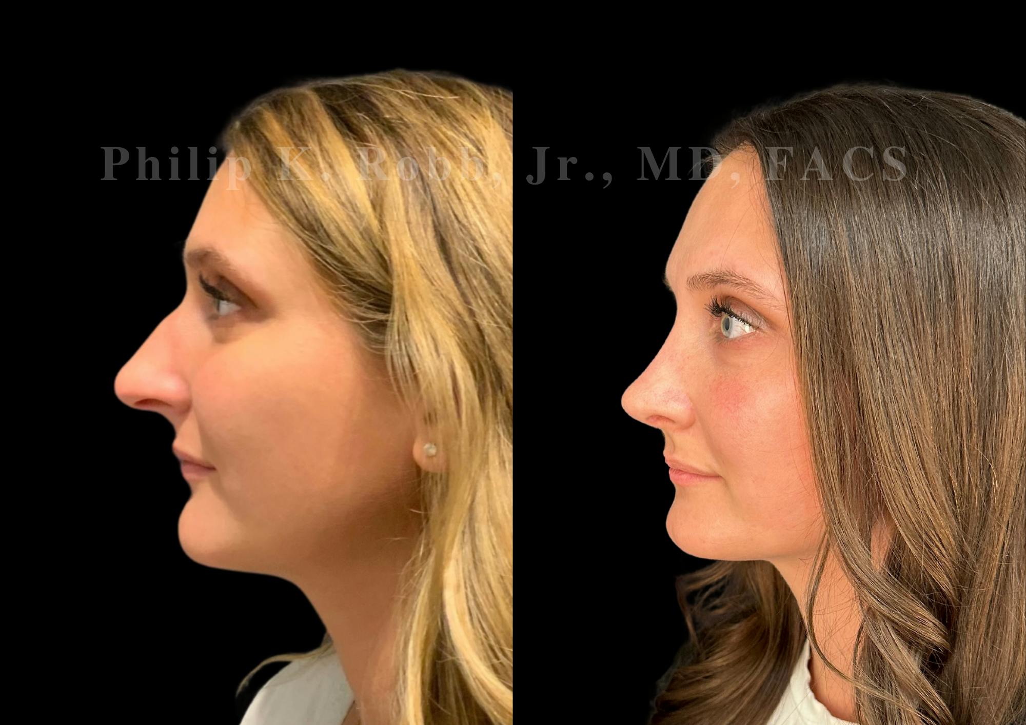 Ultrasonic Rhinoplasty Before & After Gallery - Patient 378534 - Image 5
