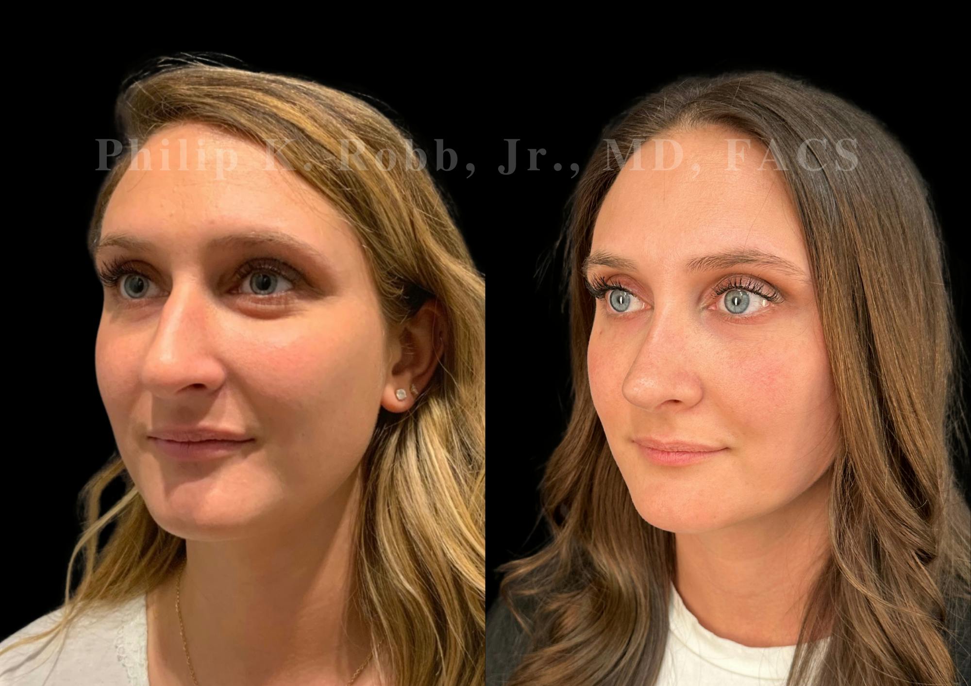 Ultrasonic Rhinoplasty Before & After Gallery - Patient 378534 - Image 4
