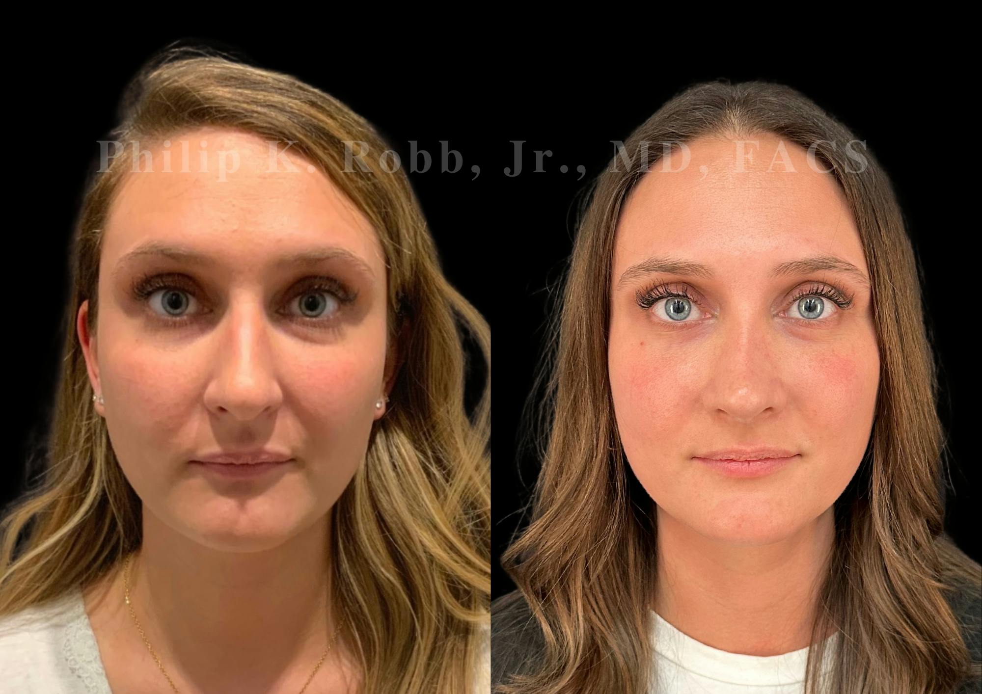 Ultrasonic Rhinoplasty Before & After Gallery - Patient 378534 - Image 3