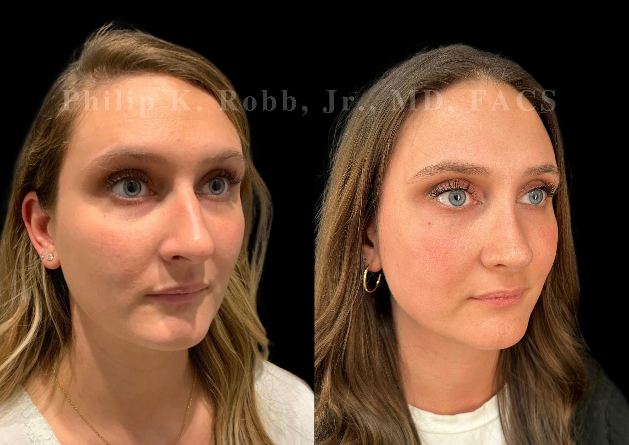 Ultrasonic Rhinoplasty Before & After Gallery - Patient 378534 - Image 2