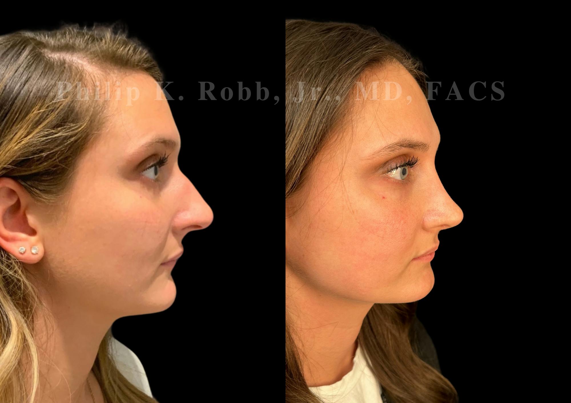 Ultrasonic Rhinoplasty Before & After Gallery - Patient 378534 - Image 1