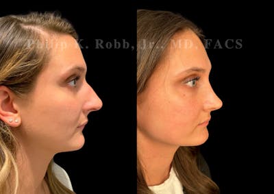 Ultrasonic Rhinoplasty Before & After Gallery - Patient 378534 - Image 1