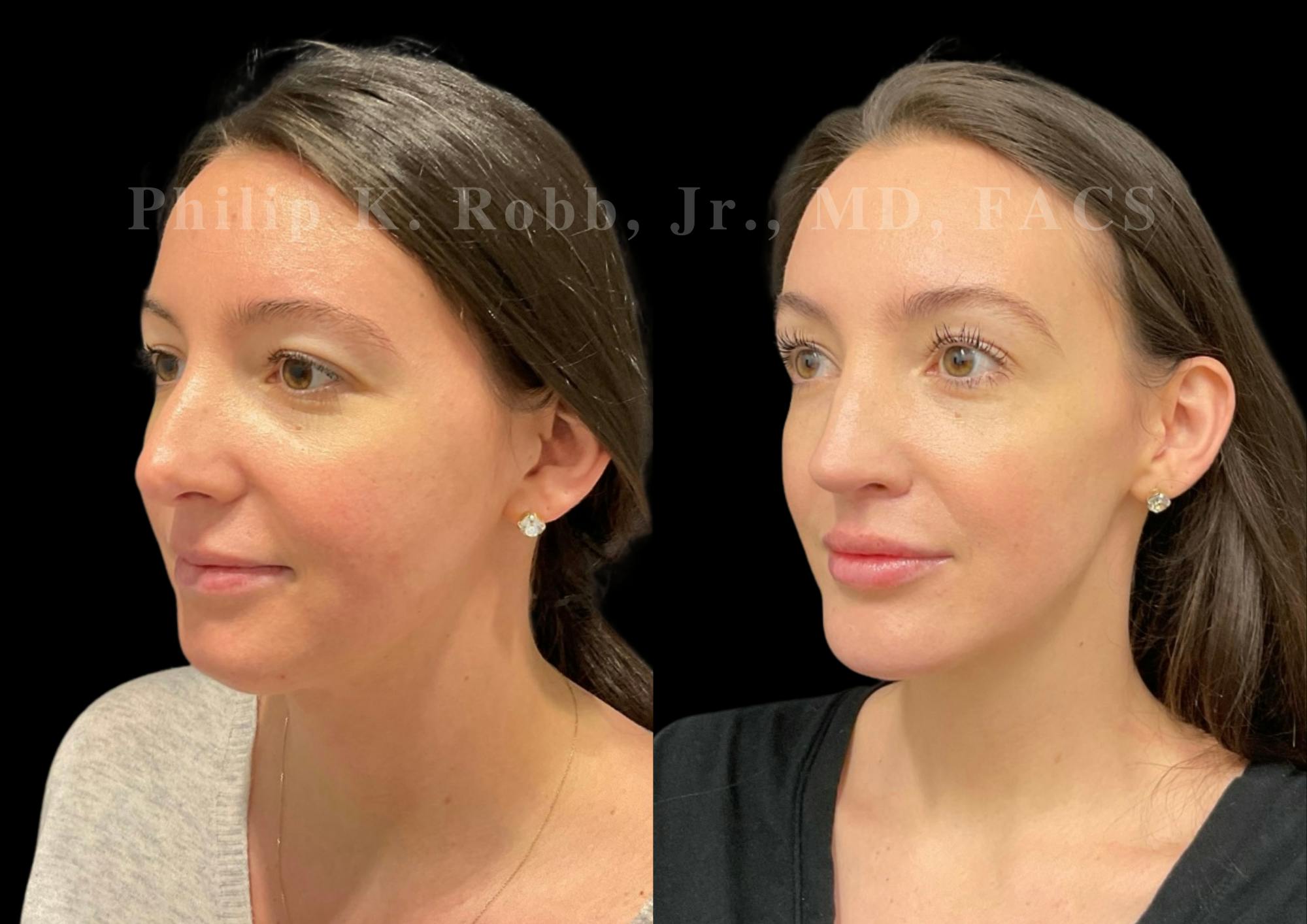 Neck Lift Before & After Gallery - Patient 120887 - Image 2