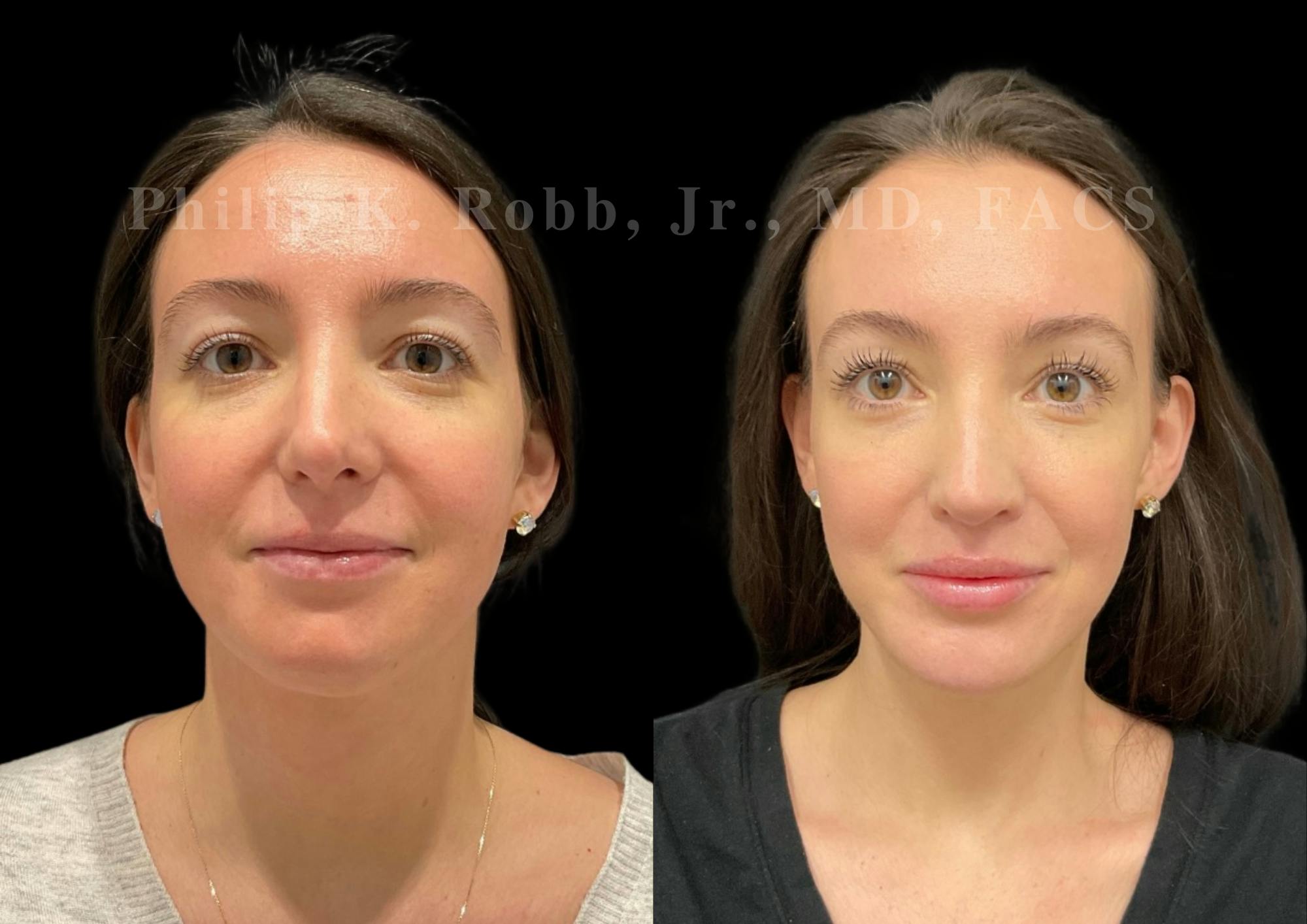 Neck Lift Before & After Gallery - Patient 120887 - Image 3
