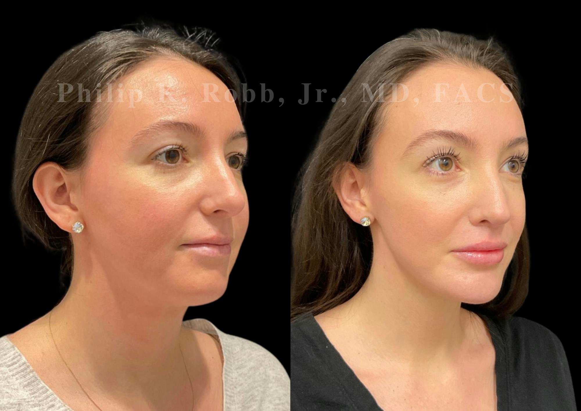 Neck Lift Before & After Gallery - Patient 120887 - Image 4