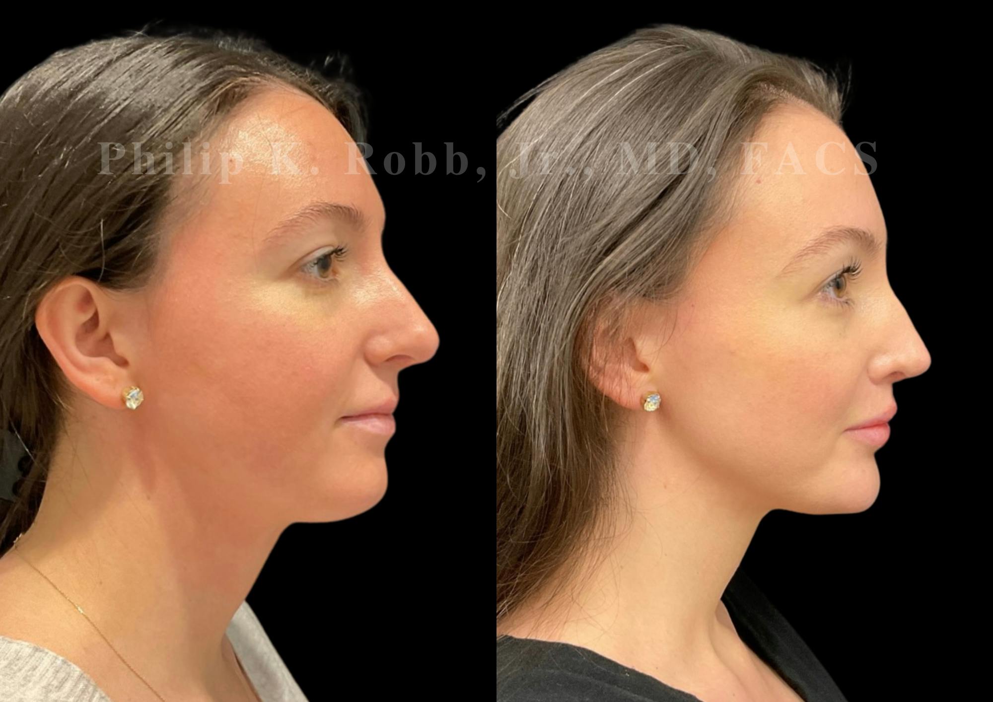 Neck Lift Before & After Gallery - Patient 120887 - Image 5