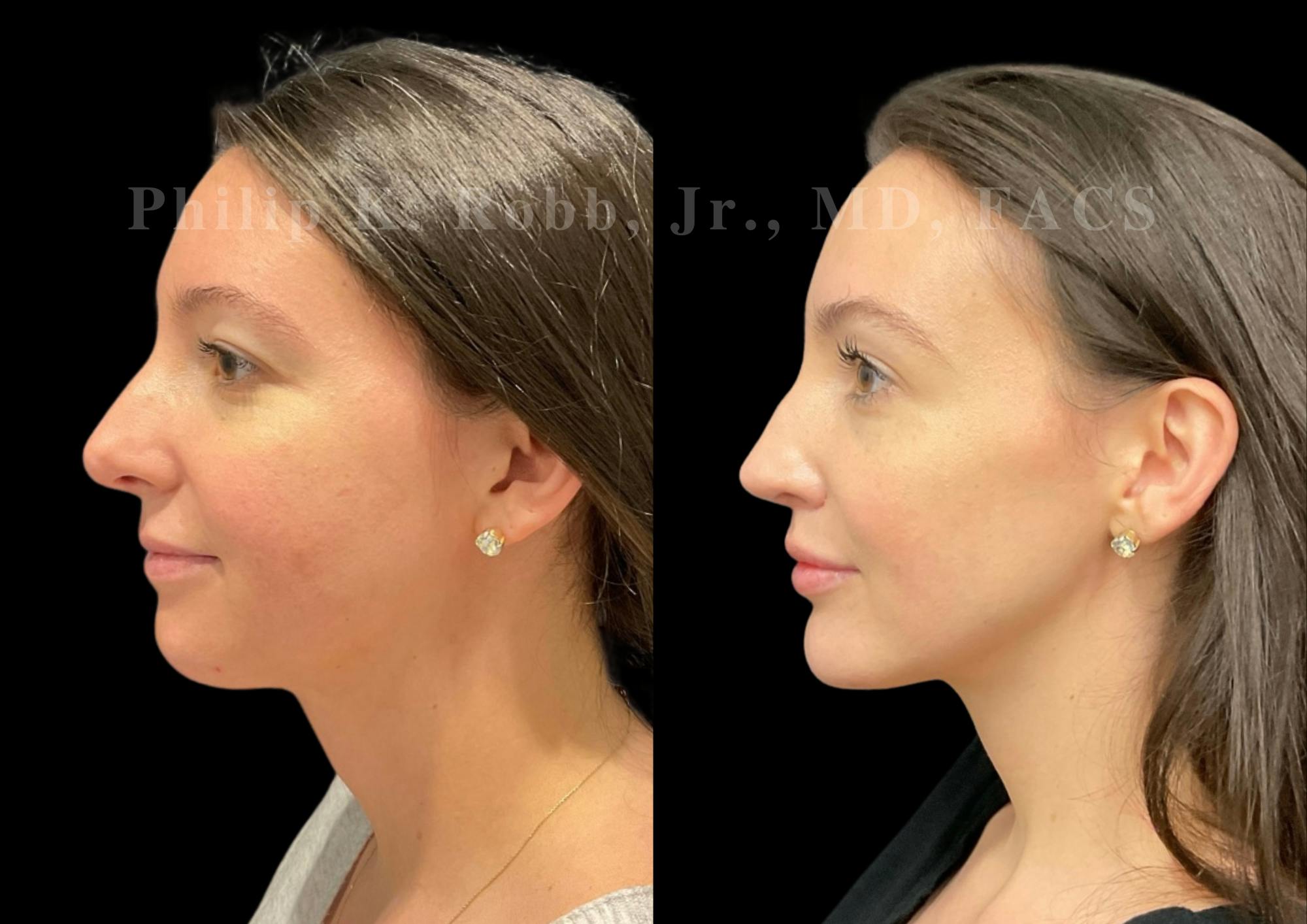 Neck Lift Before & After Gallery - Patient 120887 - Image 1