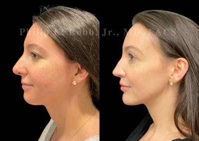 Neck Lift Before & After Gallery - Patient 120887 - Image 1