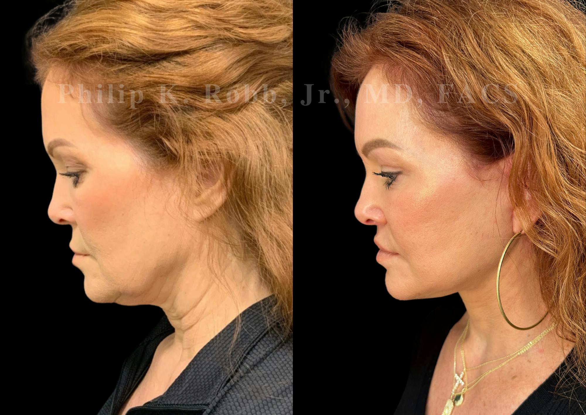 Neck Lift Before & After Gallery - Patient 213752 - Image 2
