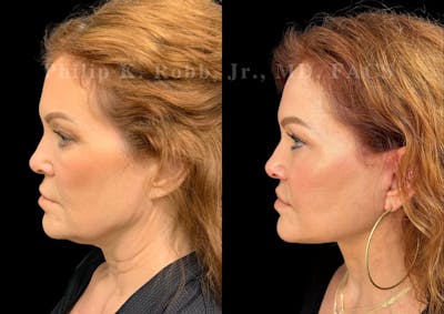 Neck Lift Before & After Gallery - Patient 213752 - Image 1