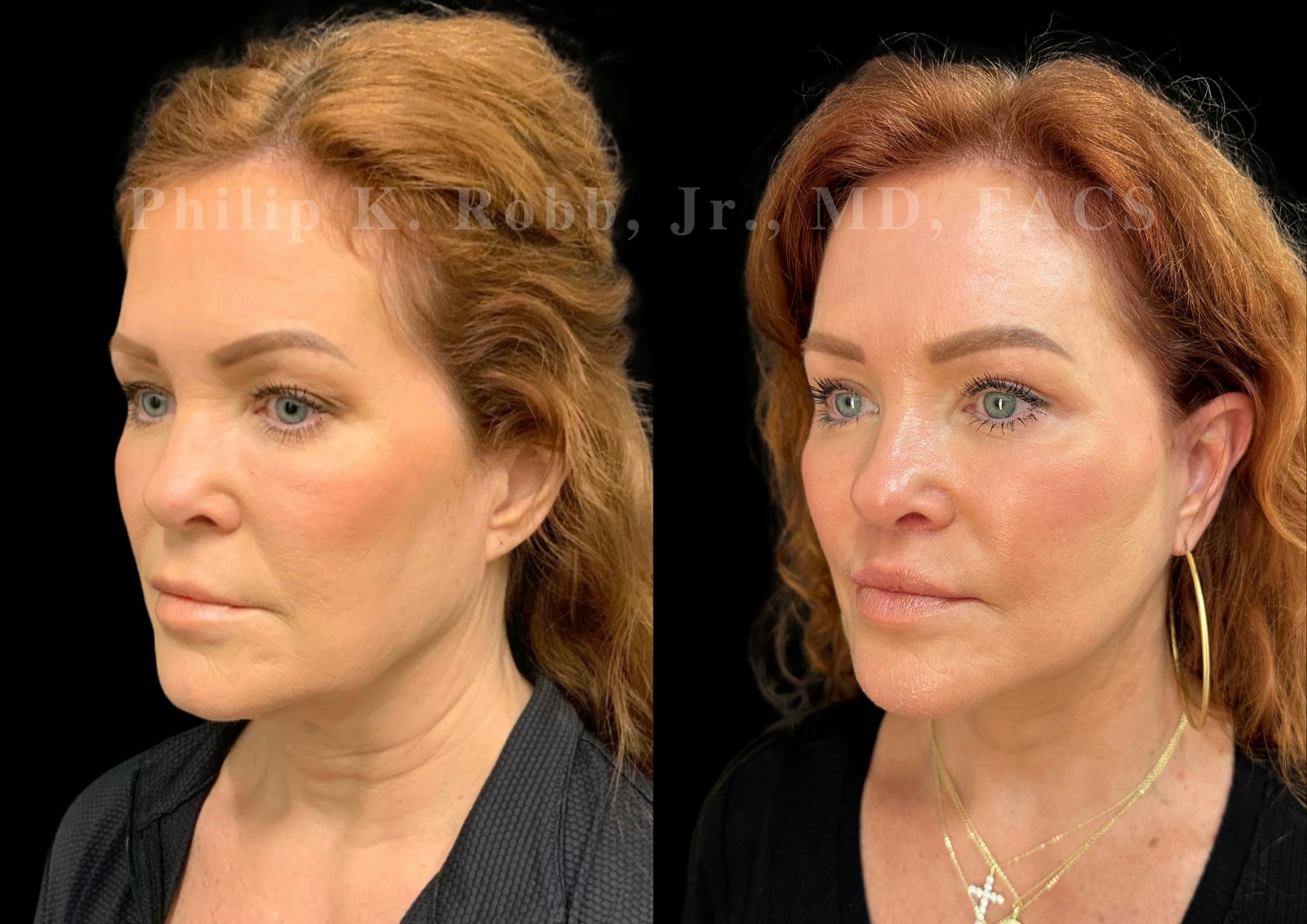 Neck Lift Before & After Gallery - Patient 213752 - Image 3