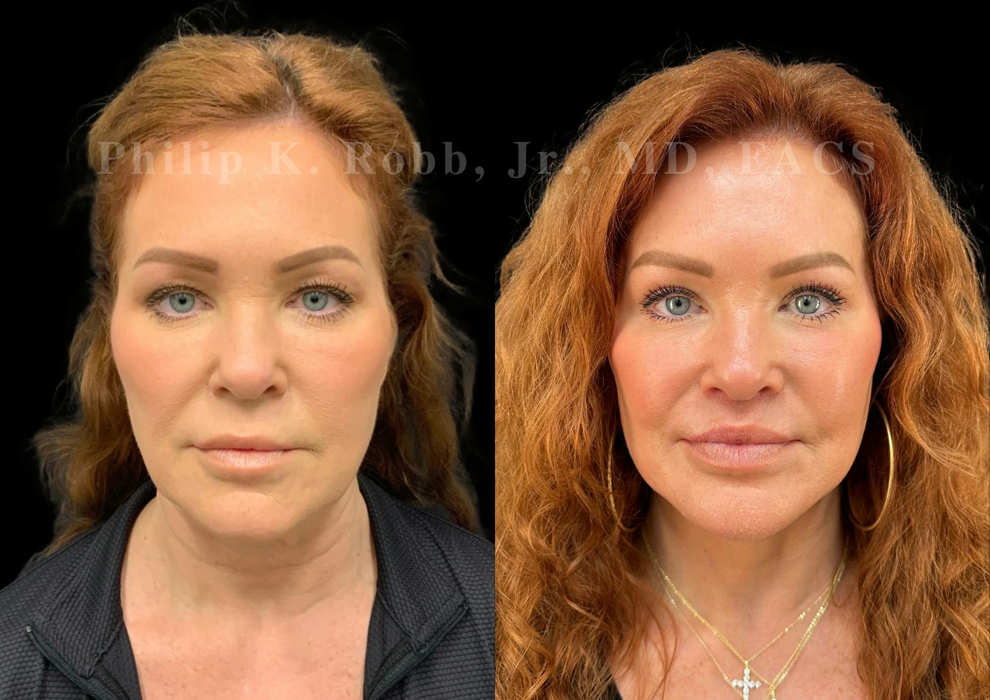 Neck Lift Before & After Gallery - Patient 213752 - Image 4