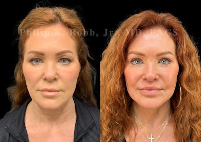 Lip Lift Before & After Gallery - Patient 606253 - Image 1
