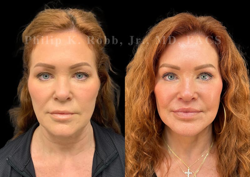 Upper Blepharoplasty