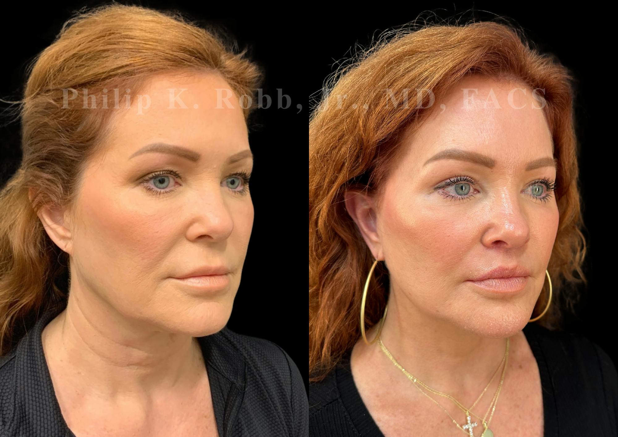 Neck Lift Before & After Gallery - Patient 213752 - Image 5