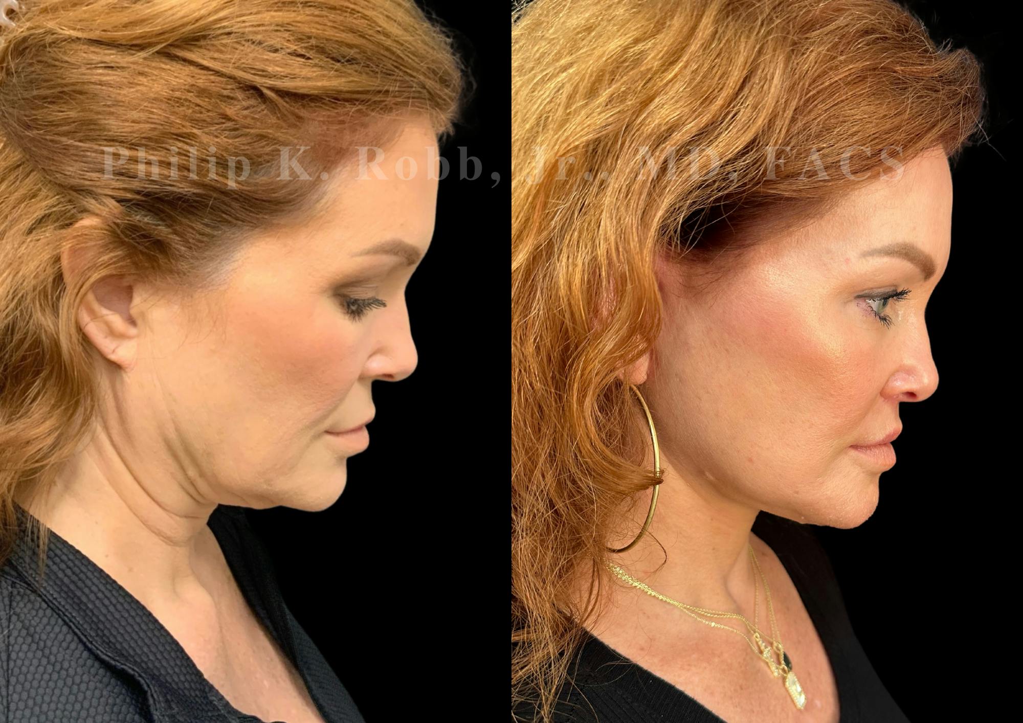 Neck Lift Before & After Gallery - Patient 213752 - Image 7