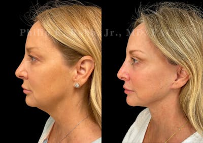 Neck Lift Before & After Gallery - Patient 263207 - Image 1
