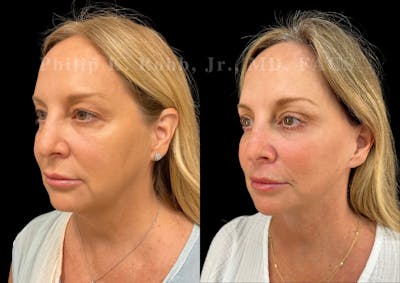 Facelift Before & After Gallery - Patient 389820 - Image 1