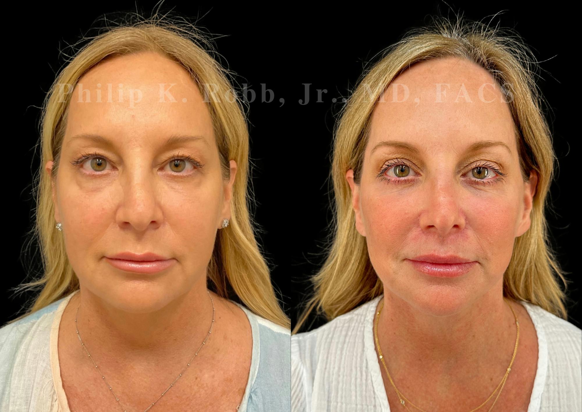 Neck Lift Before & After Gallery - Patient 263207 - Image 3