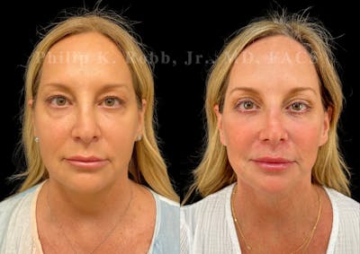Lip Lift Before & After Gallery - Patient 257189 - Image 1