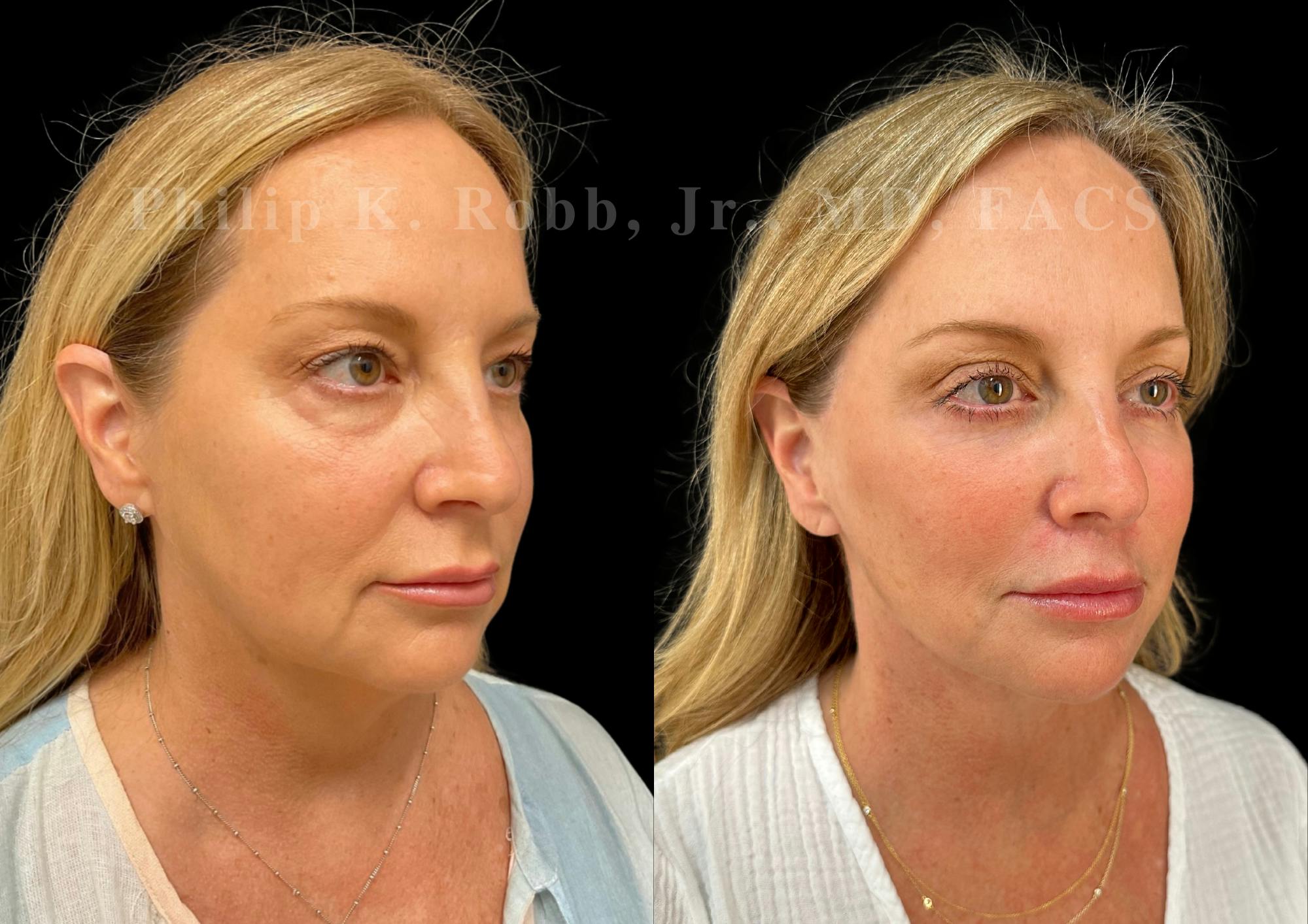 Neck Lift Before & After Gallery - Patient 263207 - Image 4