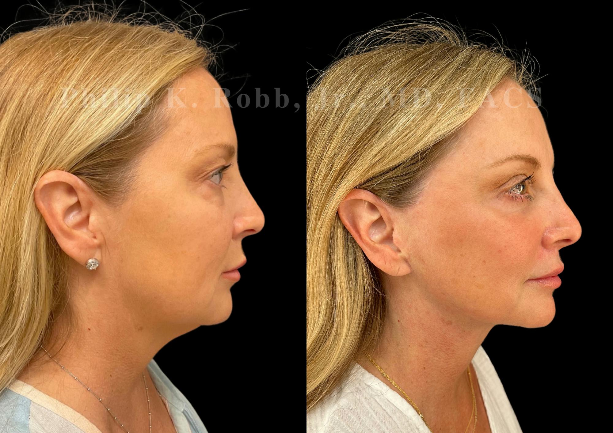 Neck Lift Before & After Gallery - Patient 263207 - Image 5