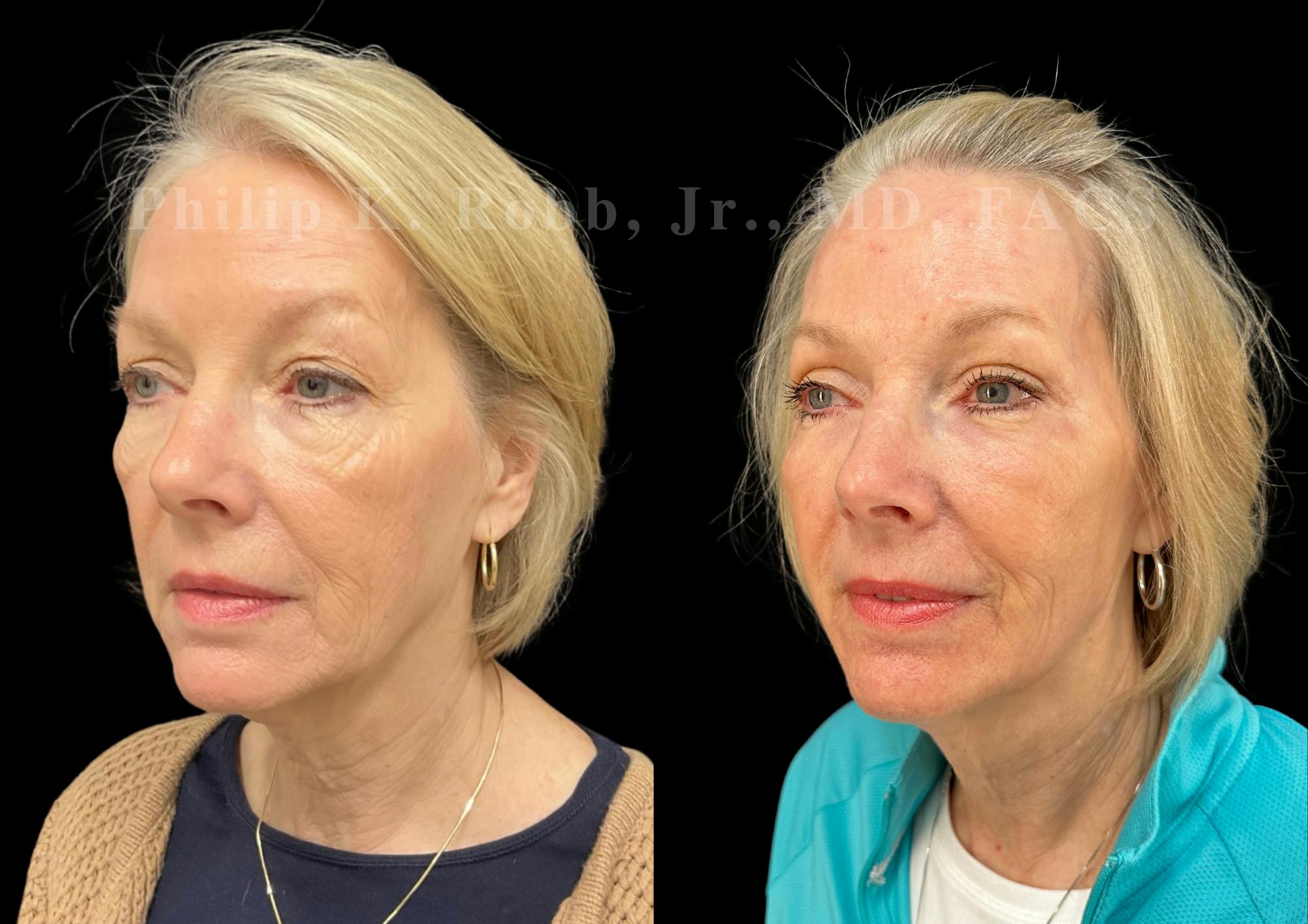 Upper Blepharoplasty Before & After Gallery - Patient 412872 - Image 2