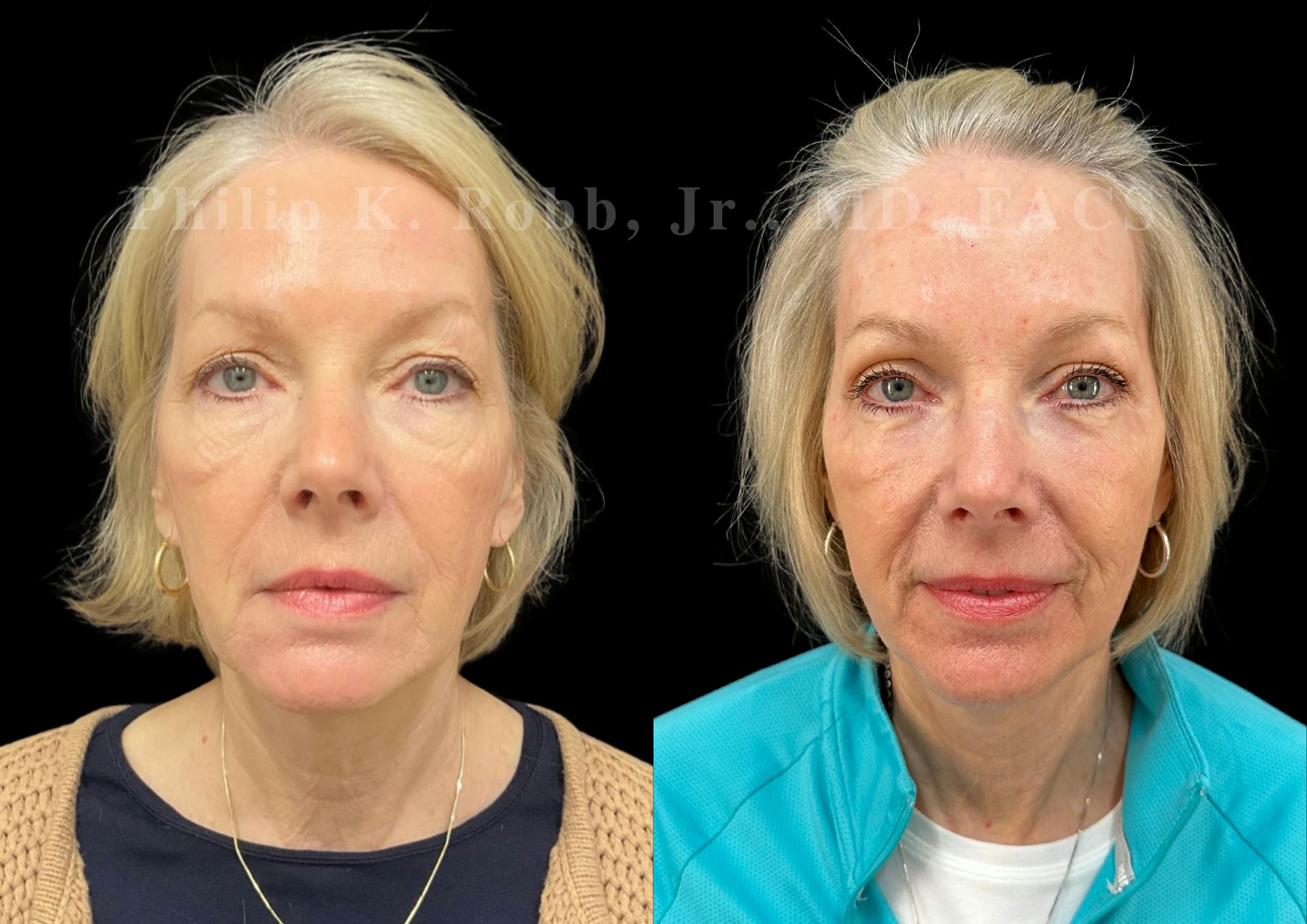 Upper Blepharoplasty Before & After Gallery - Patient 412872 - Image 1