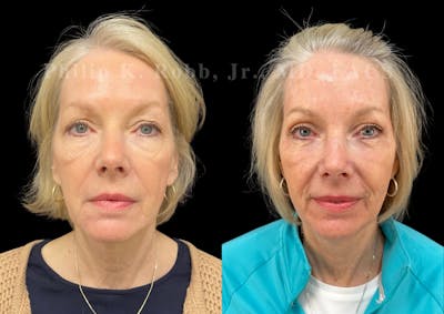 Laser Skin Resurfacing Before & After Gallery - Patient 413384 - Image 1