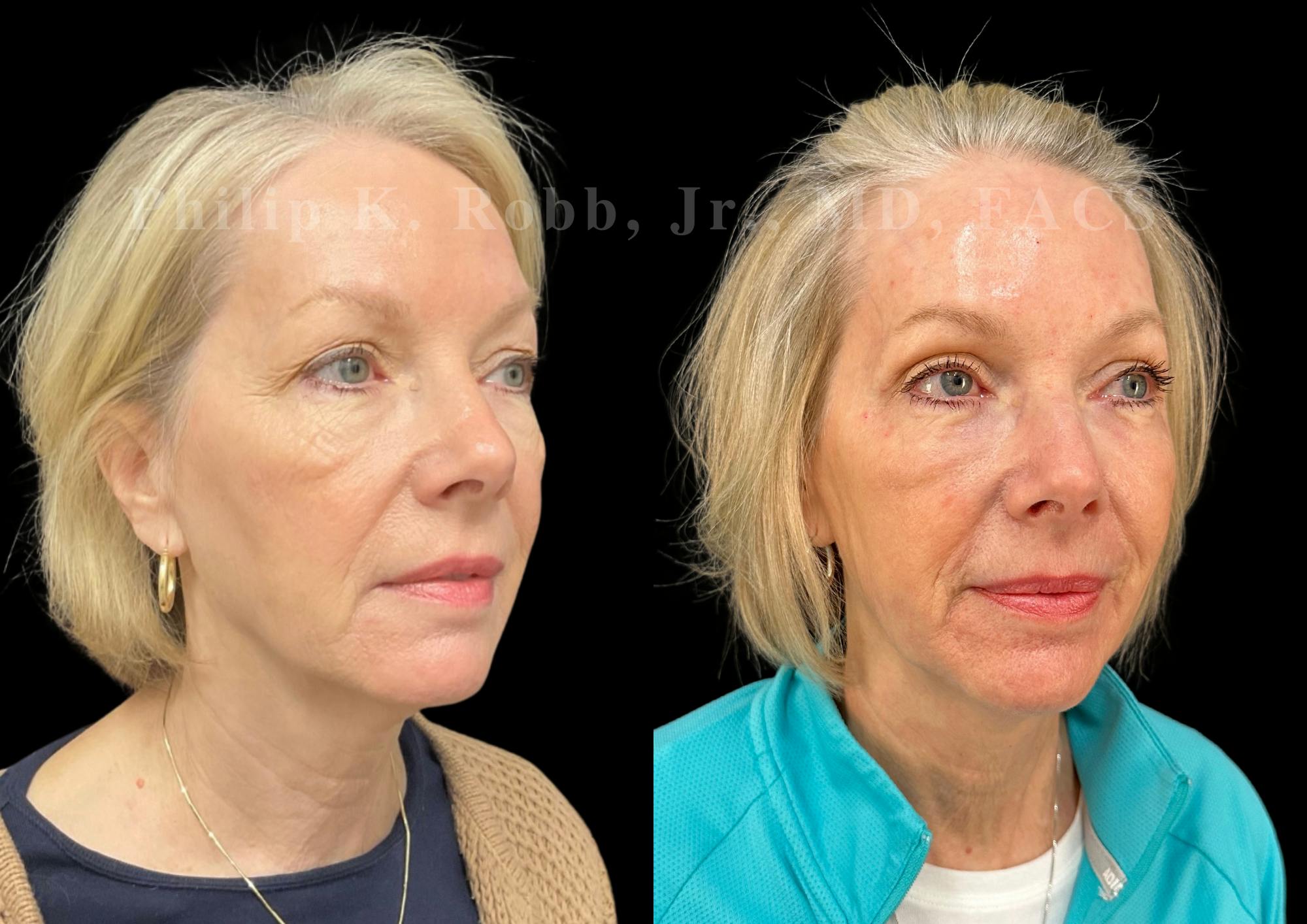 Upper Blepharoplasty Before & After Gallery - Patient 412872 - Image 3
