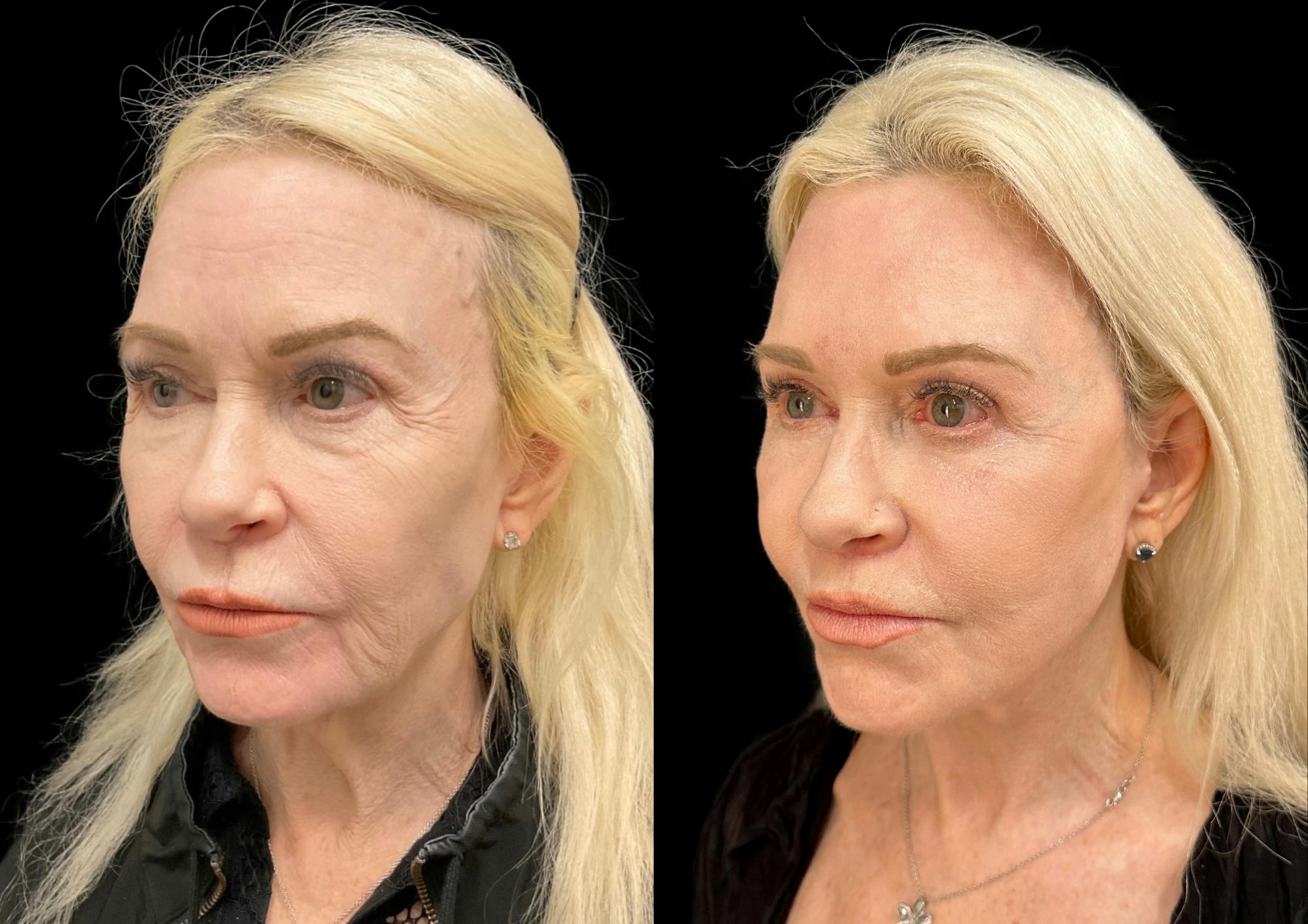 Brow Lift Before & After Gallery - Patient 224312 - Image 2