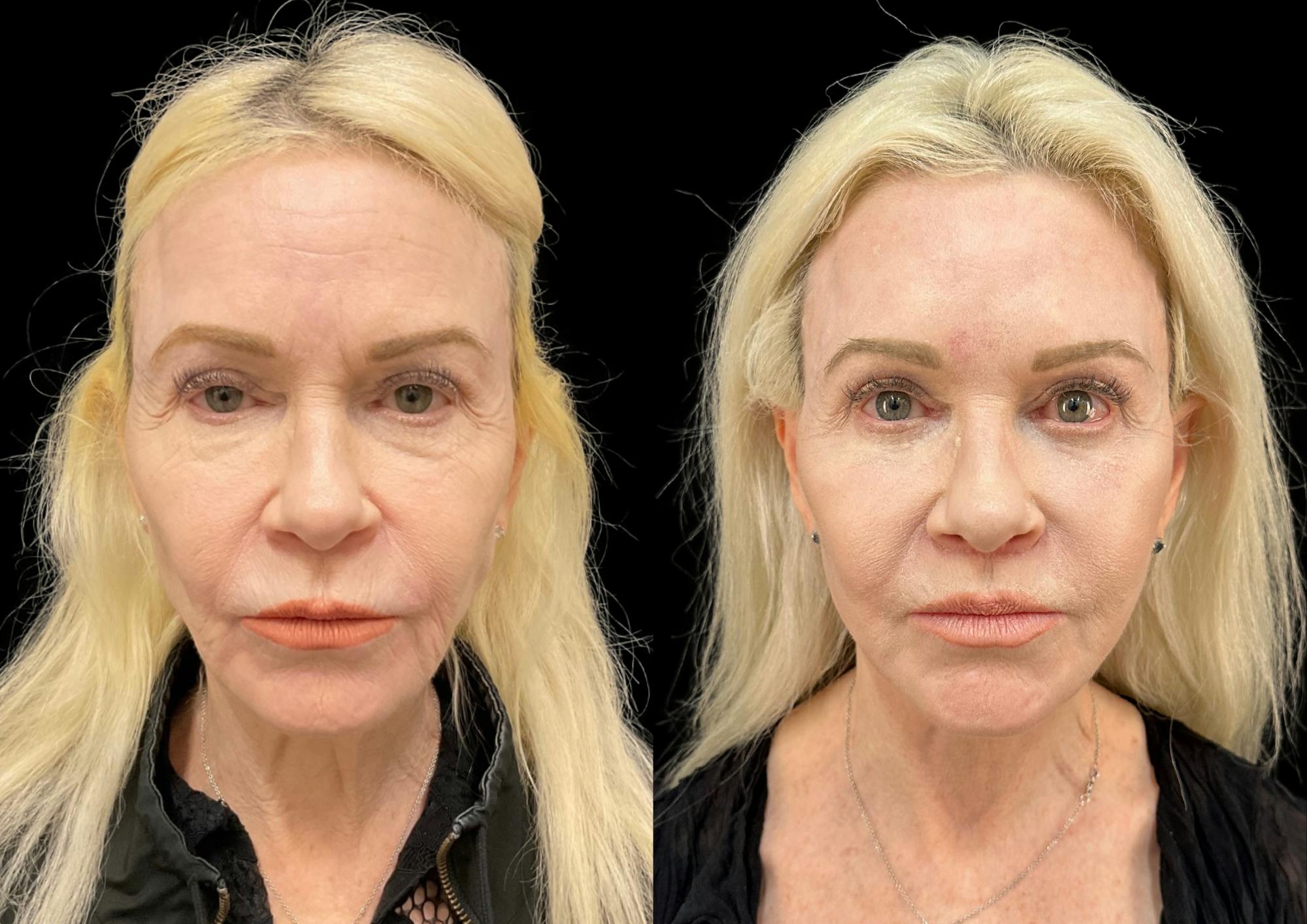Brow Lift Before & After Gallery - Patient 224312 - Image 1