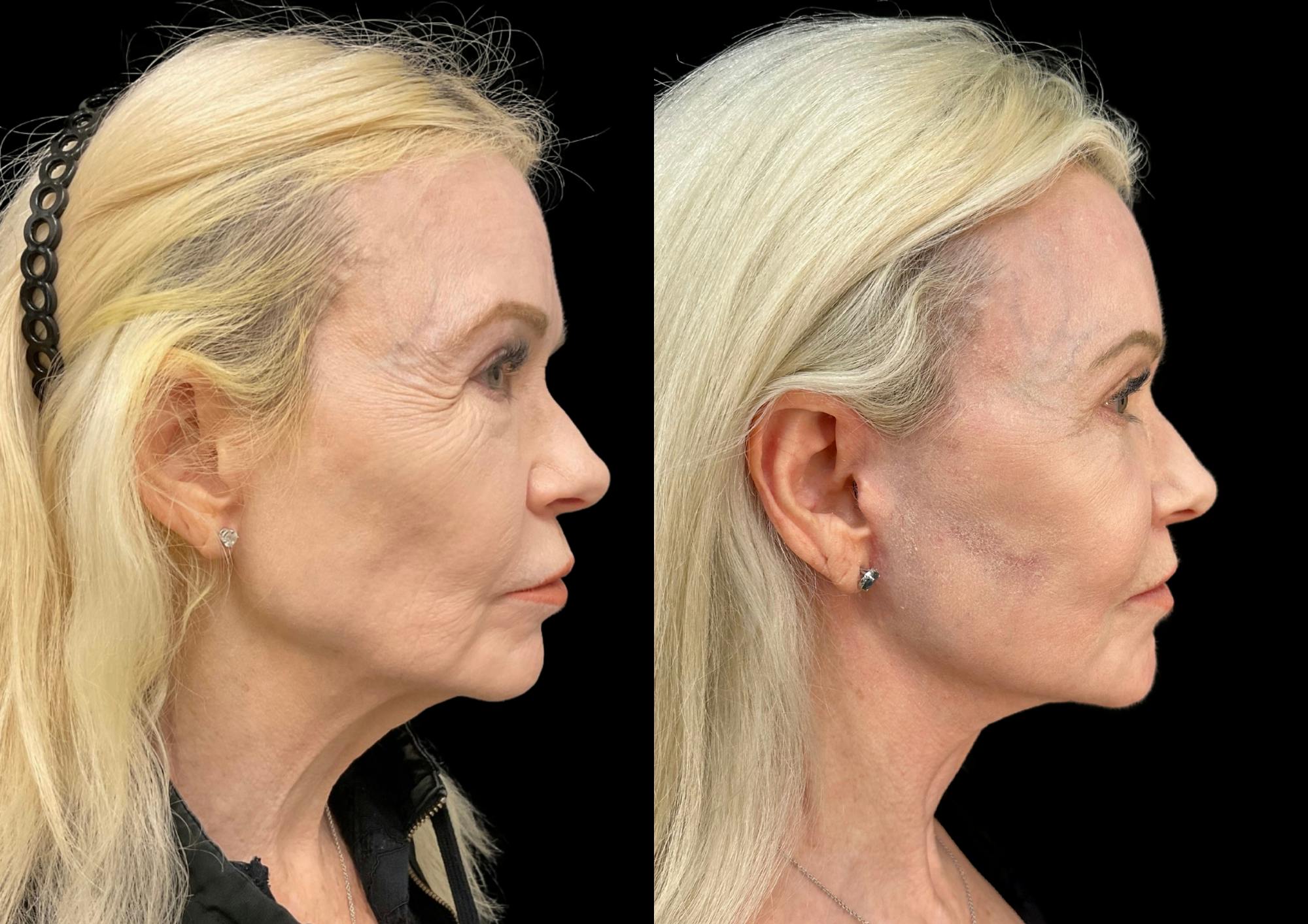 Brow Lift Before & After Gallery - Patient 224312 - Image 5