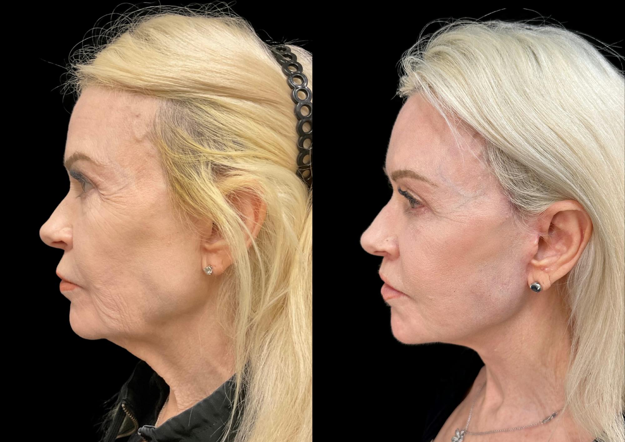 Brow Lift Before & After Gallery - Patient 224312 - Image 3