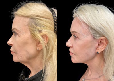 Neck Lift Before & After Gallery - Patient 472543 - Image 1