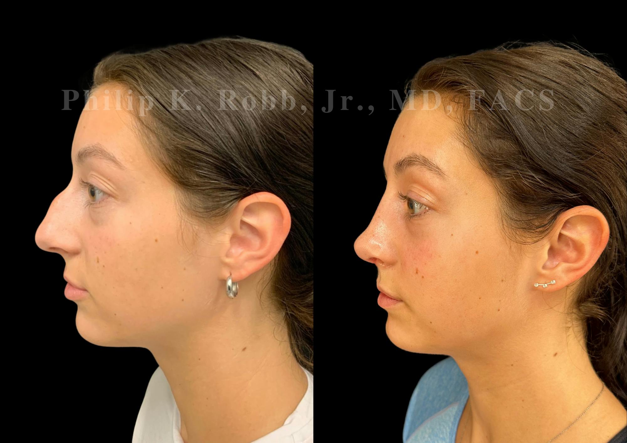 Ultrasonic Rhinoplasty Before & After Gallery - Patient 189382 - Image 5