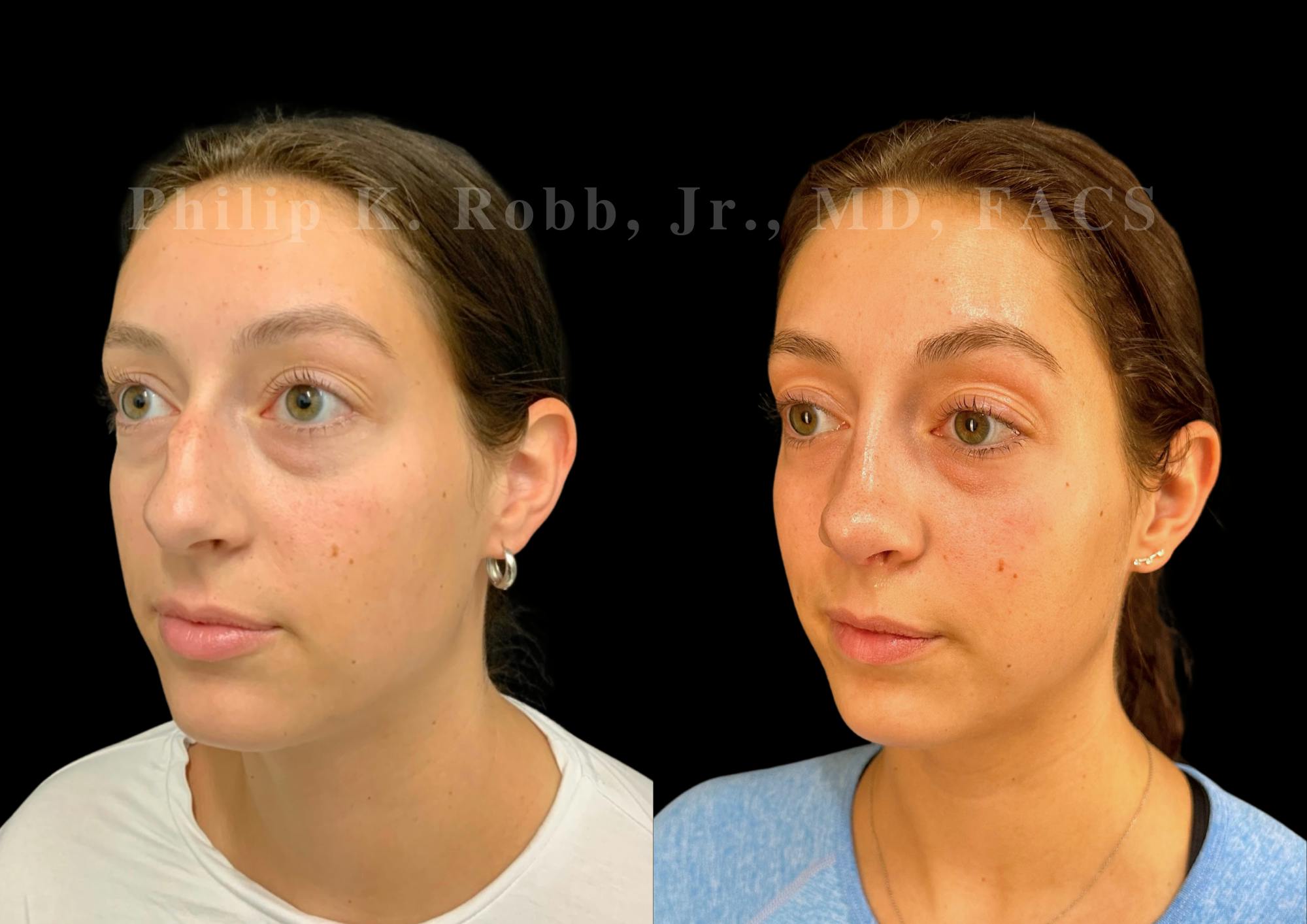 Ultrasonic Rhinoplasty Before & After Gallery - Patient 189382 - Image 4