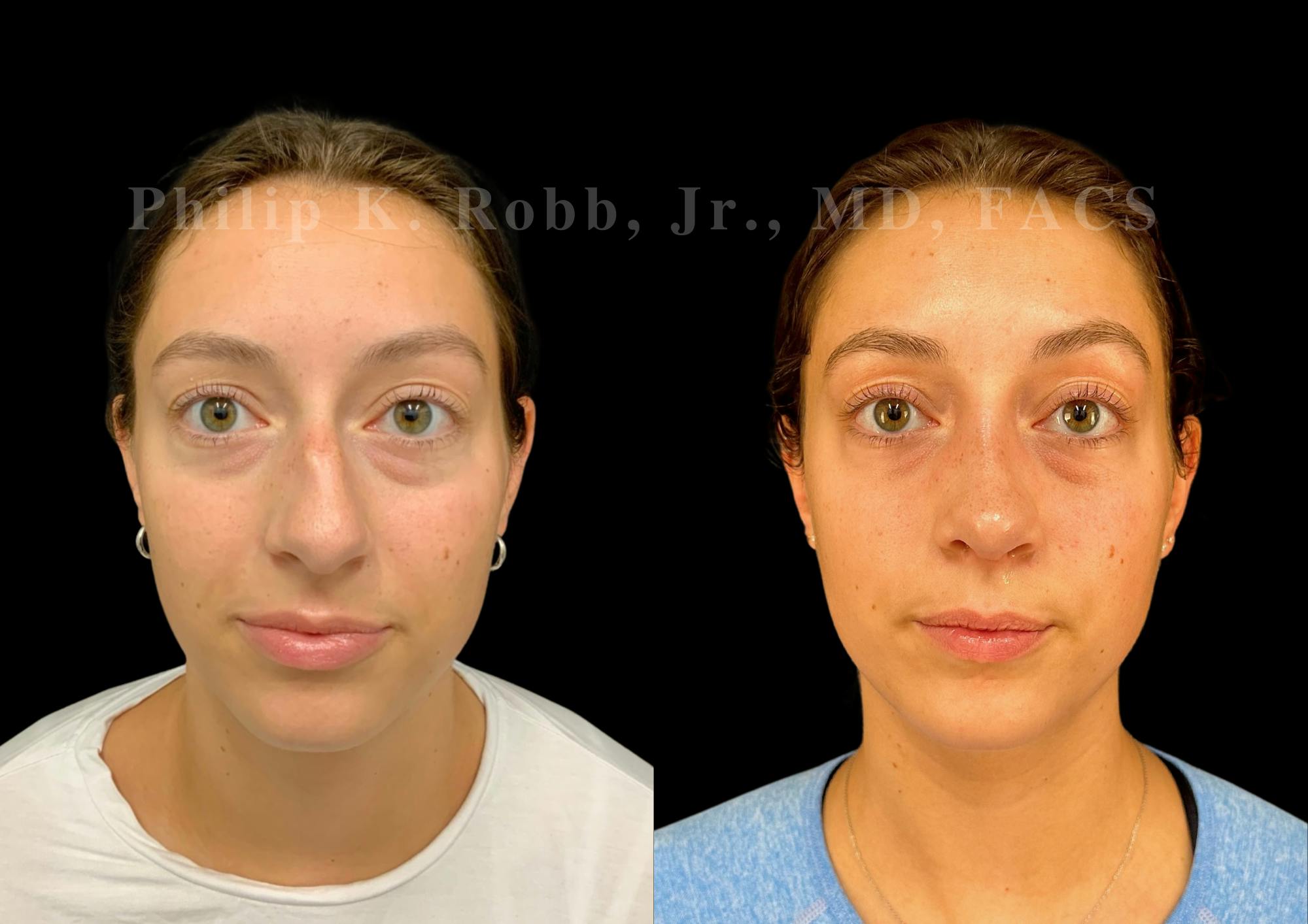 Ultrasonic Rhinoplasty Before & After Gallery - Patient 189382 - Image 3