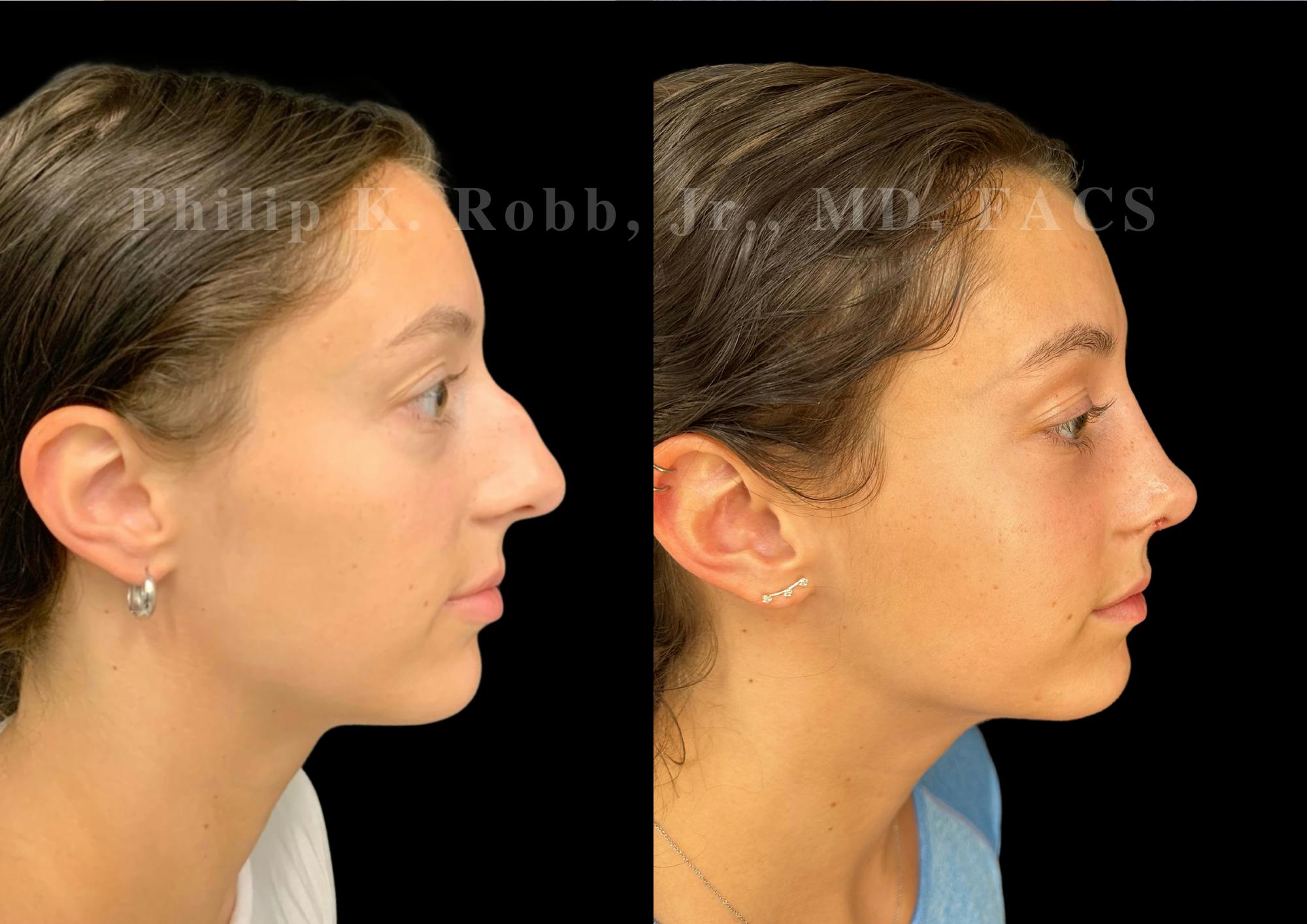 Ultrasonic Rhinoplasty Before & After Gallery - Patient 189382 - Image 1