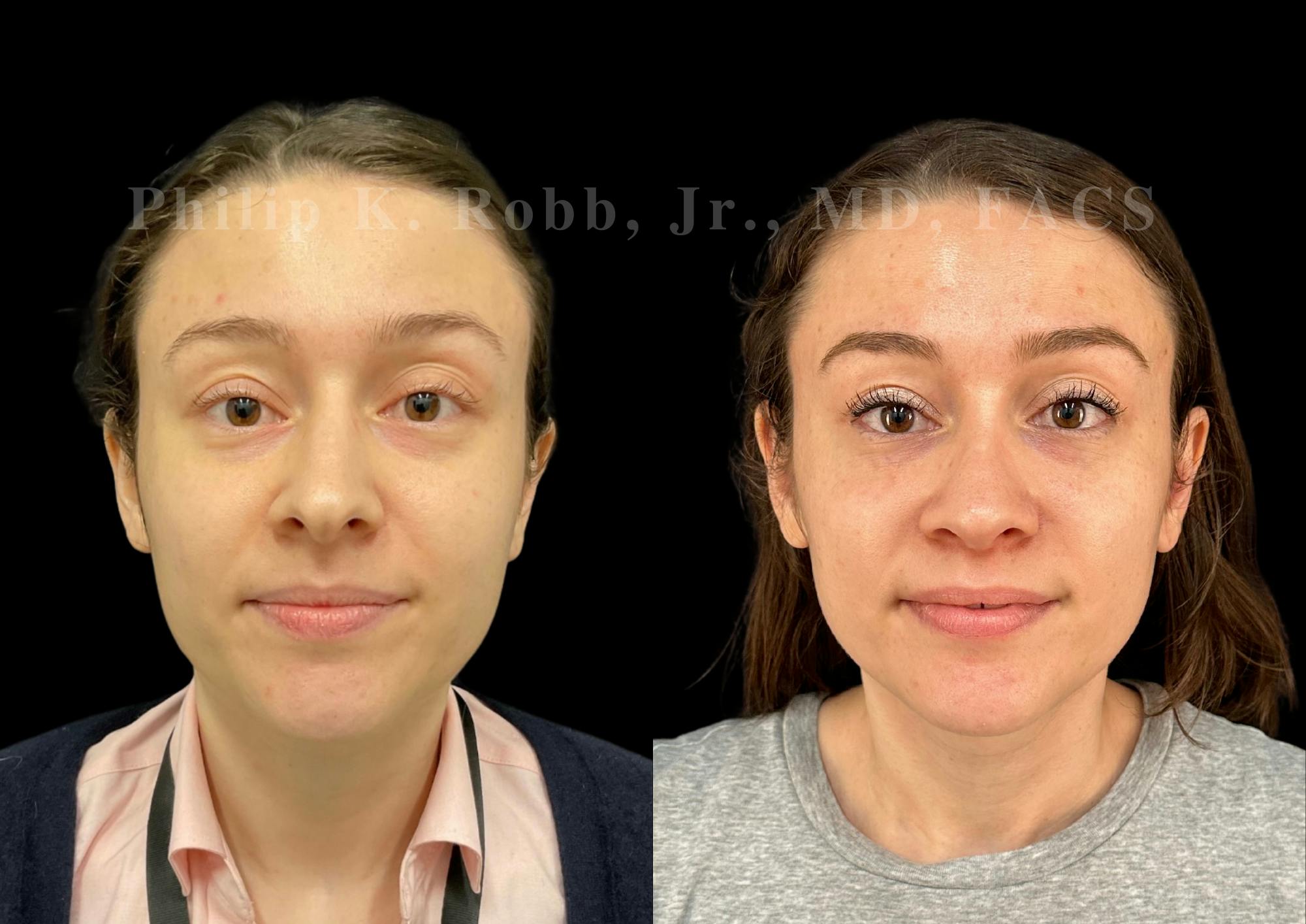 Ultrasonic Rhinoplasty Before & After Gallery - Patient 313385 - Image 3