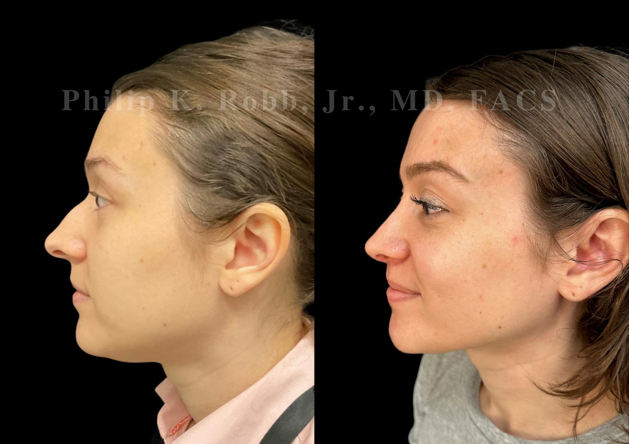 Ultrasonic Rhinoplasty Before & After Gallery - Patient 313385 - Image 5