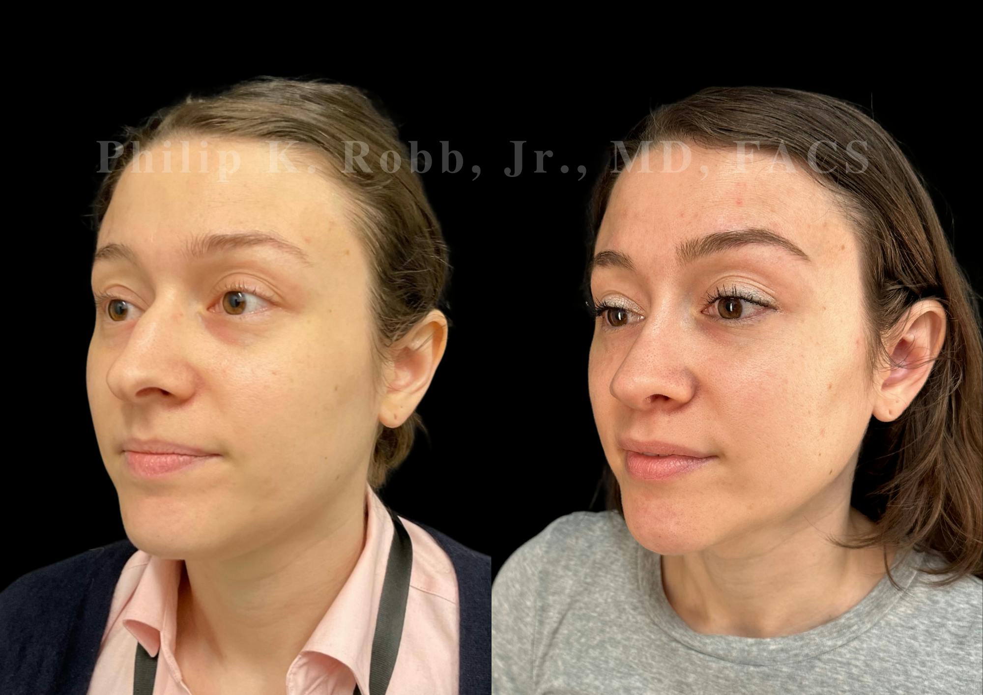 Ultrasonic Rhinoplasty Before & After Gallery - Patient 313385 - Image 4